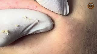 Blackheads Removal, Acne Treatment, Pimple Popping #33 Part 1