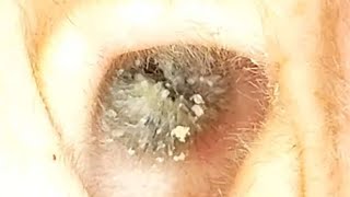 【耳掃除】#125 〜奥の獲物GET！粘着綿棒出番です〜  earwax