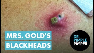 Mrs Gold's Back Blackhead Extraction Session - Addressing the Inflamed One