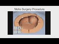 mohs micrographic technique an overview