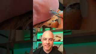 Doctor reacts to fat splinter removal! #dermreacts #doctorreacts #splinter #splinterremoval