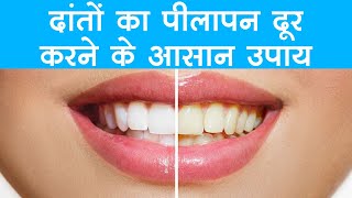 दांतों पर जमे पीले प्लाक को इन घरेलू नुस्खे से करें जड़ से साफ | how to remove yellowness from teeth