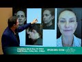 glidelift latest facelift technique with no visible scars by dr ozan sozer