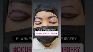 Preparation for Asian Double Fold Eyelid surgery | Asian blepharoplasty| eyelid surgery #shorts