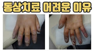 동상 치료가 어려운 이유 1,2,3,4도 동상과 치료 과정, 응급처치 및 후유증