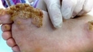 Extreme Warts | Embarrassing Bodies