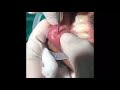 mucocele lower lip excision