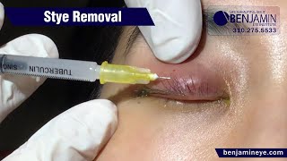 Best Stye Removal In-Office Procedure