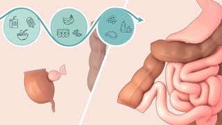 Ileocolic resection for Crohn's disease | Patient Education | TVASurg