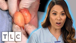 Dr. Lee Removes 68 LIPOMAS From A Patient's Arms | Dr. Pimple Popper | UNCENSORED | 18+