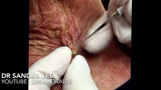 Spitting sutures and popping blackheads. For medical education- NSFE.