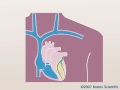 Pacemaker Implant