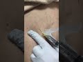 spider vein treatment with sclerotherapy