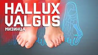 Hallux Valgus мизинца. Что с ним делать?