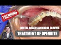 Openbite Treatment with Dental Braces and IZC Bone Screws - #braces #smilemakeover #vlog  #vlogs