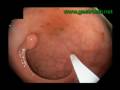 Endoscopic Polypectomy of a Rectal Tubular Adenoma