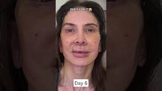 INSANE 2-Week Facelift Healing and Recovery Process!