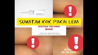 Akhirnya Di sunat .. | Sunat Metode Tekno Bond | Tanpa Jahit Tanpa Perban |