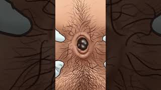 ASMR Dirt and stone removal in deep belly button| Remove Huge Navel Stone Animation
