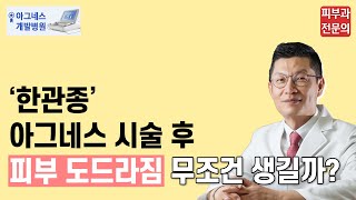 한관종 아그네스 후 도드라짐, 무조건 생길까요?