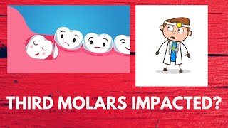 What Are The Factors Associated With Third Molars Impaction? -Oral Surgery