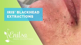 Iris Blackhead Extractions