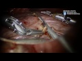 liver cancer robotic hepatectomy video brigham and women s hospital