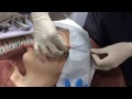 FACELIFT - V-LIFT | 线雕技术  Dr DANIEL CHANG | Korean Skin Clinic