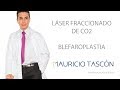 Láser fraccionado de Co2 y Blefaroplástia