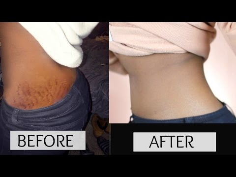 HOW TO GET RID OF STRETCH MARKS & SCARS FAST! HOW TO GET RID OF STRETCH MARKS & SCARS FAST!