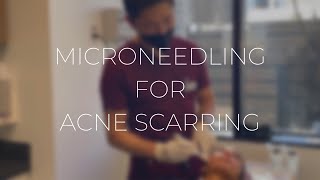 MICRONEEDLING FOR ACNE SCARRING | METROPOLIS DERMATOLOGY