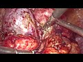 Endometriosis Surgery- Laparoscopic Management of Frozen Pelvis