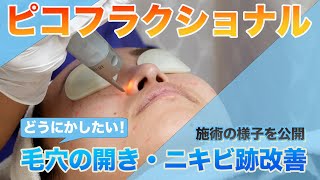 【施術動画】ピコフラクショナルレーザーで毛穴の開き、ニキビ跡の凹みを改善！