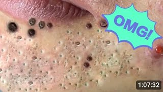 Acne RELAX|20 This What Your Remove Blackheads Should Popping mitesser pickel สิว spa neu 2025 new