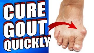How To Get Rid of Gout Naturally in 24 HOURS