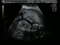 baby scan