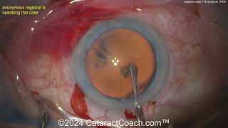 CataractCoach™ 2406: registrar case 110 analysis