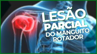 COMO RESOLVER UMA LESÃO PARCIAL DO MANGUITO ROTADOR?  ›› DR RODRIGO PASTORE ‹‹