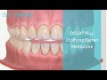 OSSIX PLUS Resorbable Collagen Dental Membrane 2014