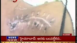 Bullet in Boy Body at Warangal - TV5