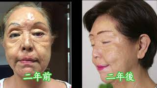 辣木油使用見證 Moringa Oil Testimony