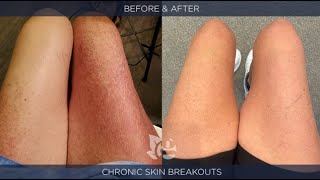 Severe, Chronic Skin Rash Reversed and Health RESTORED!