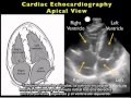 Procedimiento para realizar una ecocardiografía - Vista apical