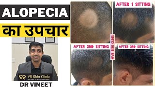Alopecia Areata के कारण और ईलाज | गंजेपन का ईलाज |VR Skin Clinic |Dr Vineet | Dr Rekha | Bikaner