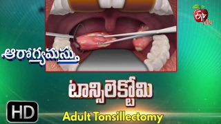 Aarogyamastu | Adult Tonsillectomy | 21st February 2017 | ఆరోగ్యమస్తు