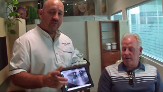 All on 6 dental implant case with Doctor German Arzate