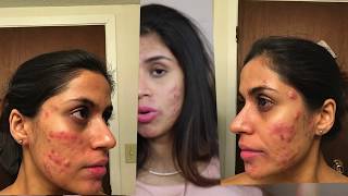 Accutane Buying