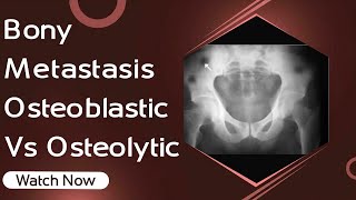 Bony Metastasis | Osteoblastic Vs Osteolytic | Orthopaedic Academy