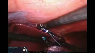 FreeHold Surgical: Utilizing FreeHold Trio® Retractor robotic paraesophageal hernia repair w/ LINX®