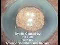 Management of uveitis caused by Iris tuck with an anterior chamber IOL.  Shannon Wong, MD